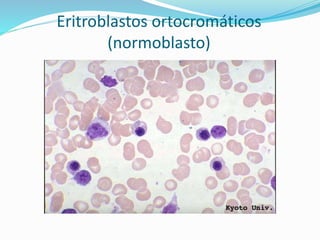 Eritroblastos ortocromáticos
(normoblasto)
 
