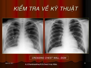 29April 25, 2017
KIEÅM TRA VEÀ KYÕ THUAÄT
A.J.Chandrasekhar,M.D.Chest X-ray Atlas.
CROSSING CHEST WALL SIGN
 