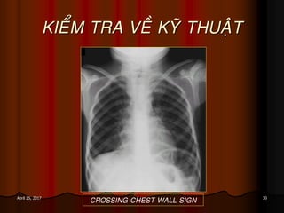 30April 25, 2017
KIEÅM TRA VEÀ KYÕ THUAÄT
CROSSING CHEST WALL SIGN
 
