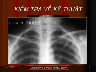 31April 25, 2017
KIEÅM TRA VEÀ KYÕ THUAÄT
CROSSING CHEST WALL SIGN
 
