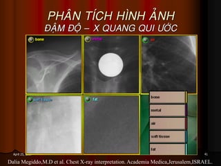 41April 25, 2017
PHAÂN TÍCH HÌNH AÛNH
ÑAÄM ÑOÄ – X QUANG QUI ÖÔÙC
Dalia Megiddo,M.D et al. Chest X-ray interpretation. Academia Medica,Jerusalem,ISRAEL.
 