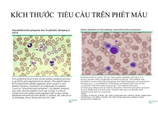 KÍCH THƢỚC TIỂU CẦU TRÊN PHẾT MÁU
 