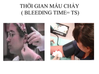 THỜI GIAN MÁU CHẢY
( BLEEDING TIME= TS)
 