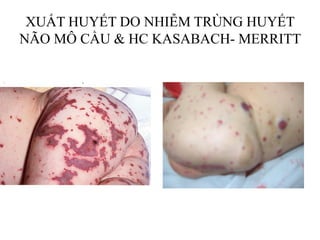 XUẤT HUYẾT DO NHIỄM TRÙNG HUYẾT
NÃO MÔ CẦU & HC KASABACH- MERRITT
 