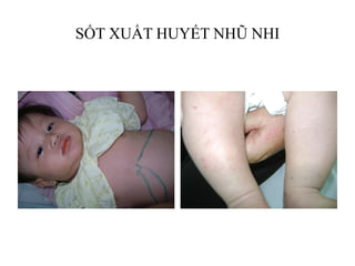 SỐT XUẤT HUYẾT NHŨ NHI
 