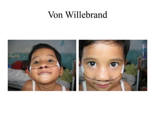 Von Willebrand
 