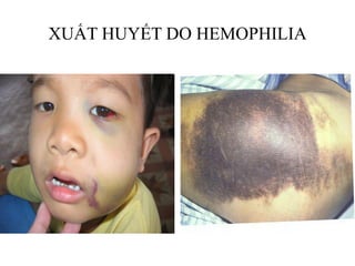XUẤT HUYẾT DO HEMOPHILIA
 