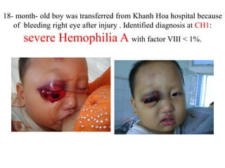 18- month- old boy was transferred from Khanh Hoa hospital because
of bleeding right eye after injury . Identified diagnosis at CH1:
severe Hemophilia A with factor VIII < 1%.
 