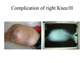 Complication of right Knee/H
 