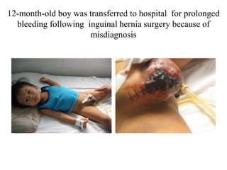 12-month-old boy was transferred to hospital for prolonged
bleeding following inguinal hernia surgery because of
misdiagnosis
 