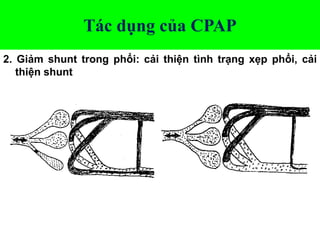 Tác dụng của CPAP
2. Giảm shunt trong phổi: cải thiện tình trạng xẹp phổi, cải
thiện shunt
 