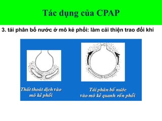 Tác dụng của CPAP
3. tái phân bố nước ở mô kẻ phổi: làm cải thiện trao đổi khí
 