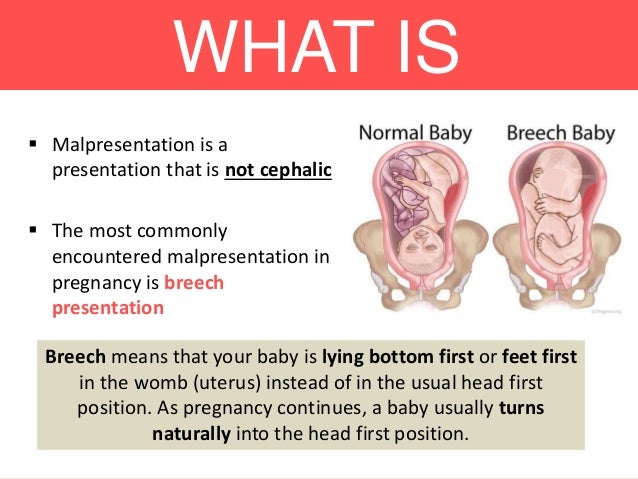 what does breech presentation means in pregnancy