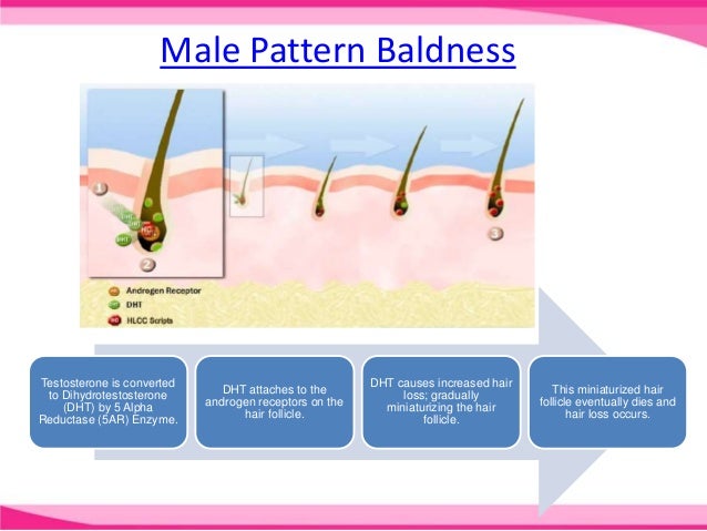 6 Male Pattern Baldness Testosterone 6 Male Pattern Baldness Testosterone