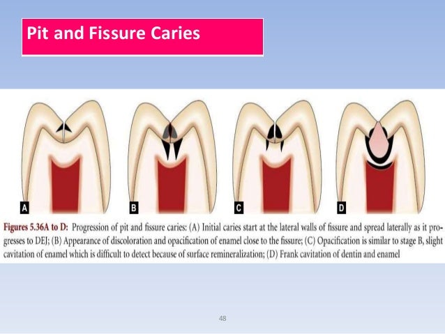 2.dental caries