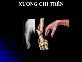 XƢƠNG CHI TRÊN
 