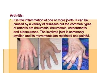Arthritis:Arthritis:
 It is the inflammation of one or more joints. It can beIt is the inflammation of one or more joints. It can be
caused by a variety of diseases but the common typescaused by a variety of diseases but the common types
of arthritis are rheumatic, rheumatoid, osteoarthritisof arthritis are rheumatic, rheumatoid, osteoarthritis
and tuberculoses. The involved joint is commonlyand tuberculoses. The involved joint is commonly
swollen and its movements are restricted and painful.swollen and its movements are restricted and painful.
 