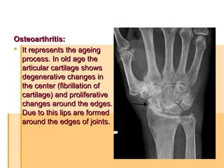 Osteoarthritis:Osteoarthritis:
 It represents the ageingIt represents the ageing
process. In old age theprocess. In old age the
articular cartilage showsarticular cartilage shows
degenerative changes indegenerative changes in
the center (fibrillation ofthe center (fibrillation of
cartilage) and proliferativecartilage) and proliferative
changes around the edges.changes around the edges.
Due to this lips are formedDue to this lips are formed
around the edges of joints.around the edges of joints.
 