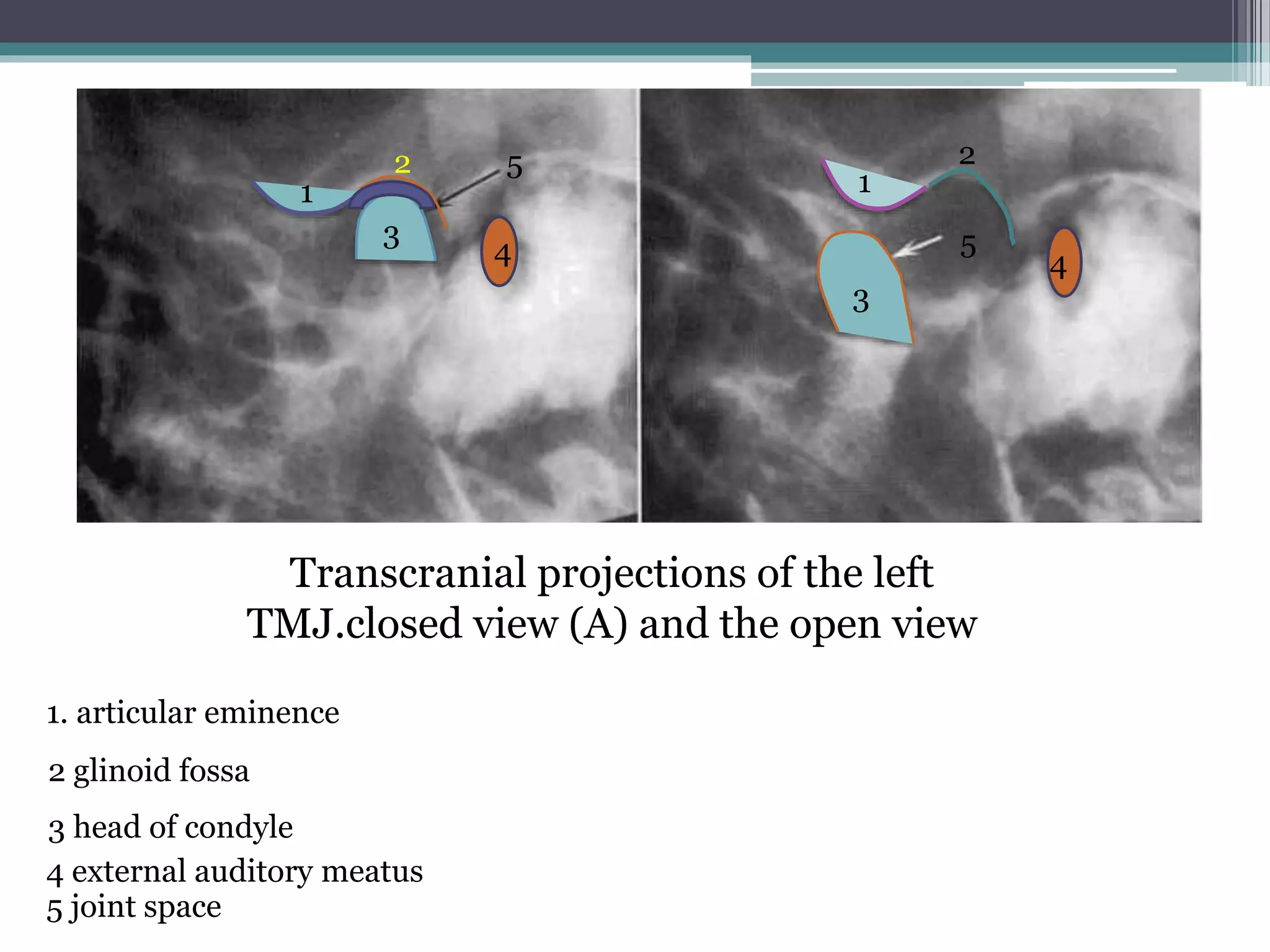 TMJ Radiology Applied Aspect PPTX TMJ Radiology Applied Aspect PPTX