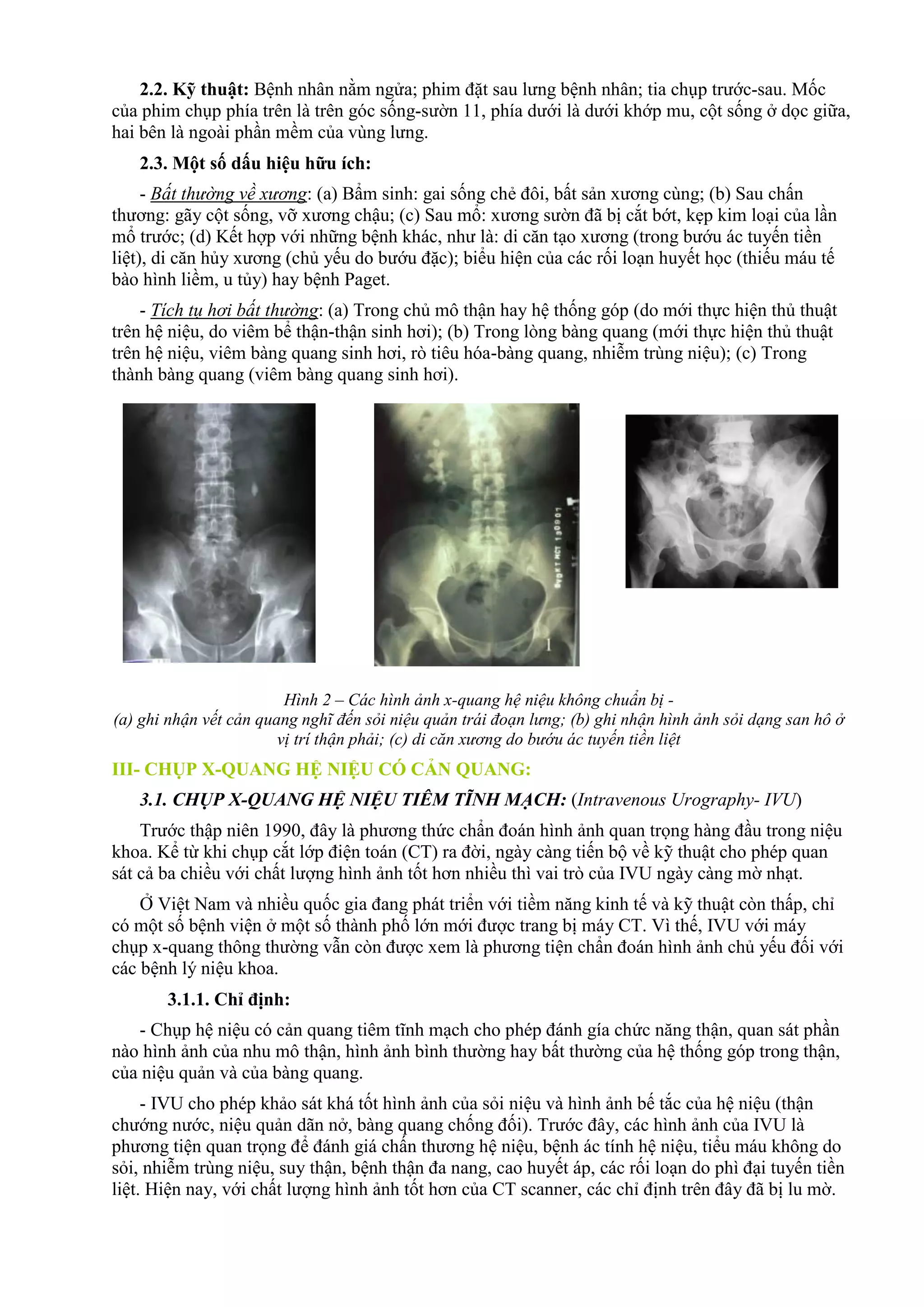 2.2. Kỹ thuật: Bệnh nhân nằm ngửa; phim đặt sau lưng bệnh nhân; tia chụp trước-sau. Mốc
của phim chụp phía trên là trên góc sống-sườn 11, phía dưới là dưới khớp mu, cột sống ở dọc giữa,
hai bên là ngoài phần mềm của vùng lưng.
2.3. Một số dấu hiệu hữu ích:
- Bất thường về xương: (a) Bẩm sinh: gai sống chẻ đôi, bất sản xương cùng; (b) Sau chấn
thương: gãy cột sống, vỡ xương chậu; (c) Sau mổ: xương sườn đã bị cắt bớt, kẹp kim loại của lần
mổ trước; (d) Kết hợp với những bệnh khác, như là: di căn tạo xương (trong bướu ác tuyến tiền
liệt), di căn hủy xương (chủ yếu do bướu đặc); biểu hiện của các rối loạn huyết học (thiếu máu tế
bào hình liềm, u tủy) hay bệnh Paget.
- Tích tụ hơi bất thường: (a) Trong chủ mô thận hay hệ thống góp (do mới thực hiện thủ thuật
trên hệ niệu, do viêm bể thận-thận sinh hơi); (b) Trong lòng bàng quang (mới thực hiện thủ thuật
trên hệ niệu, viêm bàng quang sinh hơi, rò tiêu hóa-bàng quang, nhiễm trùng niệu); (c) Trong
thành bàng quang (viêm bàng quang sinh hơi).
Hình 2 – Các hình ảnh x-quang hệ niệu không chuẩn bị -
(a) ghi nhận vết cản quang nghĩ đến sỏi niệu quản trái đoạn lưng; (b) ghi nhận hình ảnh sỏi dạng san hô ở
vị trí thận phải; (c) di căn xương do bướu ác tuyến tiền liệt
III- CHỤP X-QUANG HỆ NIỆU CÓ CẢN QUANG:
3.1. CHỤP X-QUANG HỆ NIỆU TIÊM TĨNH MẠCH: (Intravenous Urography- IVU)
Trước thập niên 1990, đây là phương thức chẩn đoán hình ảnh quan trọng hàng đầu trong niệu
khoa. Kể từ khi chụp cắt lớp điện toán (CT) ra đời, ngày càng tiến bộ về kỹ thuật cho phép quan
sát cả ba chiều với chất lượng hình ảnh tốt hơn nhiều thì vai trò của IVU ngày càng mờ nhạt.
Ở Việt Nam và nhiều quốc gia đang phát triển với tiềm năng kinh tế và kỹ thuật còn thấp, chỉ
có một số bệnh viện ở một số thành phố lớn mới được trang bị máy CT. Vì thế, IVU với máy
chụp x-quang thông thường vẫn còn được xem là phương tiện chẩn đoán hình ảnh chủ yếu đối với
các bệnh lý niệu khoa.
3.1.1. Chỉ định:
- Chụp hệ niệu có cản quang tiêm tĩnh mạch cho phép đánh gía chức năng thận, quan sát phần
nào hình ảnh của nhu mô thận, hình ảnh bình thường hay bất thường của hệ thống góp trong thận,
của niệu quản và của bàng quang.
- IVU cho phép khảo sát khá tốt hình ảnh của sỏi niệu và hình ảnh bế tắc của hệ niệu (thận
chướng nước, niệu quản dãn nở, bàng quang chống đối). Trước đây, các hình ảnh của IVU là
phương tiện quan trọng để đánh giá chấn thương hệ niệu, bệnh ác tính hệ niệu, tiểu máu không do
sỏi, nhiễm trùng niệu, suy thận, bệnh thận đa nang, cao huyết áp, các rối loạn do phì đại tuyến tiền
liệt. Hiện nay, với chất lượng hình ảnh tốt hơn của CT scanner, các chỉ định trên đây đã bị lu mờ.
 