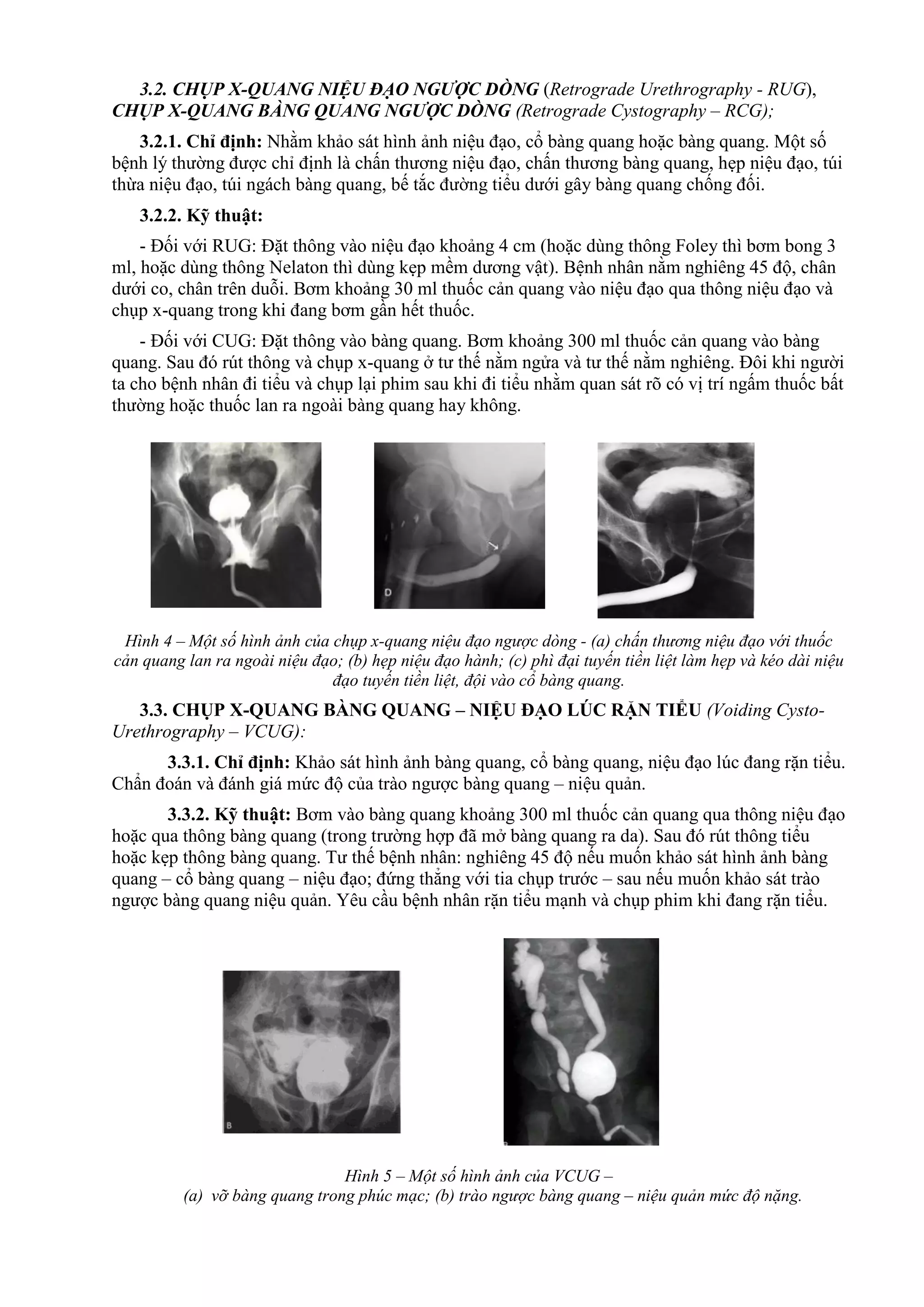 3.2. CHỤP X-QUANG NIỆU ĐẠO NGƯỢC DÒNG (Retrograde Urethrography - RUG),
CHỤP X-QUANG BÀNG QUANG NGƯỢC DÒNG (Retrograde Cystography – RCG);
3.2.1. Chỉ định: Nhằm khảo sát hình ảnh niệu đạo, cổ bàng quang hoặc bàng quang. Một số
bệnh lý thường được chỉ định là chấn thương niệu đạo, chấn thương bàng quang, hẹp niệu đạo, túi
thừa niệu đạo, túi ngách bàng quang, bế tắc đường tiểu dưới gây bàng quang chống đối.
3.2.2. Kỹ thuật:
- Đối với RUG: Đặt thông vào niệu đạo khoảng 4 cm (hoặc dùng thông Foley thì bơm bong 3
ml, hoặc dùng thông Nelaton thì dùng kẹp mềm dương vật). Bệnh nhân nằm nghiêng 45 độ, chân
dưới co, chân trên duỗi. Bơm khoảng 30 ml thuốc cản quang vào niệu đạo qua thông niệu đạo và
chụp x-quang trong khi đang bơm gần hết thuốc.
- Đối với CUG: Đặt thông vào bàng quang. Bơm khoảng 300 ml thuốc cản quang vào bàng
quang. Sau đó rút thông và chụp x-quang ở tư thế nằm ngửa và tư thế nằm nghiêng. Đôi khi người
ta cho bệnh nhân đi tiểu và chụp lại phim sau khi đi tiểu nhằm quan sát rõ có vị trí ngấm thuốc bất
thường hoặc thuốc lan ra ngoài bàng quang hay không.
Hình 4 – Một số hình ảnh của chụp x-quang niệu đạo ngược dòng - (a) chấn thương niệu đạo với thuốc
cản quang lan ra ngoài niệu đạo; (b) hẹp niệu đạo hành; (c) phì đại tuyến tiền liệt làm hẹp và kéo dài niệu
đạo tuyến tiền liệt, đội vào cổ bàng quang.
3.3. CHỤP X-QUANG BÀNG QUANG – NIỆU ĐẠO LÚC RẶN TIỂU (Voiding Cysto-
Urethrography – VCUG):
3.3.1. Chỉ định: Khảo sát hình ảnh bàng quang, cổ bàng quang, niệu đạo lúc đang rặn tiểu.
Chẩn đoán và đánh giá mức độ của trào ngược bàng quang – niệu quản.
3.3.2. Kỹ thuật: Bơm vào bàng quang khoảng 300 ml thuốc cản quang qua thông niệu đạo
hoặc qua thông bàng quang (trong trường hợp đã mở bàng quang ra da). Sau đó rút thông tiểu
hoặc kẹp thông bàng quang. Tư thế bệnh nhân: nghiêng 45 độ nếu muốn khảo sát hình ảnh bàng
quang – cổ bàng quang – niệu đạo; đứng thẳng với tia chụp trước – sau nếu muốn khảo sát trào
ngược bàng quang niệu quản. Yêu cầu bệnh nhân rặn tiểu mạnh và chụp phim khi đang rặn tiểu.
Hình 5 – Một số hình ảnh của VCUG –
(a) vỡ bàng quang trong phúc mạc; (b) trào ngược bàng quang – niệu quản mức độ nặng.
 
