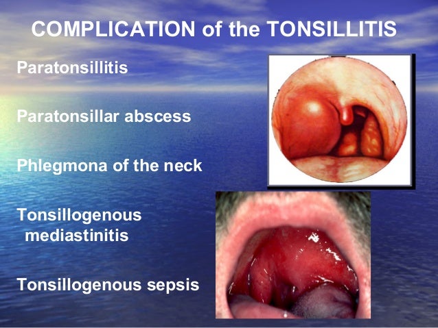 Anatomy Physiology Of Pharynx Tonsillitis
