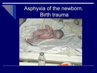 Asphyxia of the newborn.
Birth trauma
 