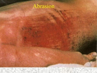 Abrasion
 
