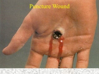 Puncture Wound
 