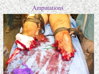 Core Skills Control Bleeding 12
Amputations
 