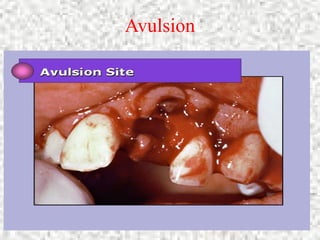 Core Skills Control Bleeding 13
Avulsion
 