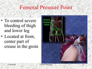 Core Skills Control Bleeding 23
Femoral Pressure Point
• To control severe
bleeding of thigh
and lower leg
• Located at front,
center part of
crease in the groin
 