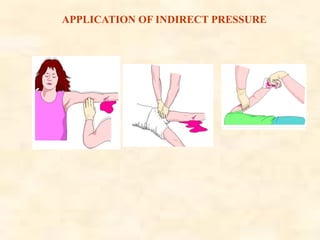 APPLICATION OF INDIRECT PRESSURE
 