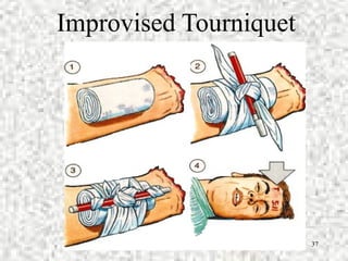 CMAST 37
Improvised Tourniquet
 