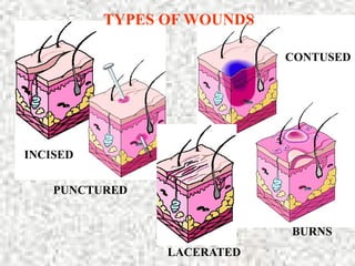INCISED
LACERATED
PUNCTURED
CONTUSED
BURNS
TYPES OF WOUNDS
 