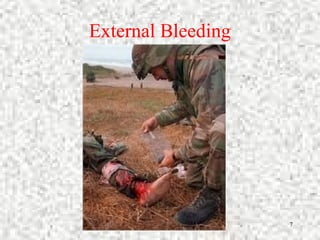 Control Bleeding 7
External Bleeding
 