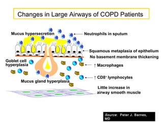 Mucus gland hyperplasia
Goblet cell
hyperplasia
Mucus hypersecretion Neutrophils in sputum
Squamous metaplasia of epithelium
↑ Macrophages
No basement membrane thickening
Little increase in
airway smooth muscle
↑ CD8+
lymphocytes
Changes in Large Airways of COPD PatientsChanges in Large Airways of COPD Patients
Source: Peter J. Barnes,
MD
 