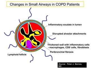 Disrupted alveolar attachments
Inflammatory exudate in lumen
Peribronchial fibrosis
Lymphoid follicle
Thickened wall with inflammatory cells
- macrophages, CD8+
cells, fibroblasts
Changes in Small Airways in COPD Patients
Source: Peter J. Barnes,
MD
 