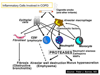 Cigarette smokeCigarette smoke
(and other irritants)(and other irritants)
PROTEASESPROTEASES
Neutrophil elastaseNeutrophil elastase
CathepsinsCathepsins
MMPsMMPs
Alveolar wall destructionAlveolar wall destruction
(Emphysema)(Emphysema)
Mucus hypersecretionMucus hypersecretion
CD8CD8++
lymphocytelymphocyte
Alveolar macrophageAlveolar macrophageEpithelialEpithelial
cellscells
FibrosisFibrosis
(Obstructive(Obstructive
bronchiolitis)bronchiolitis)
FibroblastFibroblast
MonocyteMonocyteNeutrophilNeutrophil
Chemotactic factorsChemotactic factors
Inflammatory Cells Involved in COPD
Source: Peter J. Barnes, MD
 