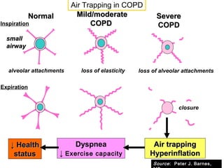 NormalNormal
Inspiration
Expiration
alveolar attachments
Mild/moderateMild/moderate
COPDCOPD
loss of elasticity
SevereSevere
COPDCOPD
loss of alveolar attachments
closure
smallsmall
airwayairway
Dyspnea
↓ Exercise capacity
Air trappingAir trapping
HyperinflationHyperinflation
↓↓ HealthHealth
statusstatus
Air Trapping in COPD
Source: Peter J. Barnes,
 
