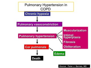 Chronic hypoxiaChronic hypoxia
Pulmonary vasoconstrictionPulmonary vasoconstriction
MuscularizationMuscularization
IntimalIntimal
hyperplasiahyperplasia
FibrosisFibrosis
ObliterationObliteration
Pulmonary hypertensionPulmonary hypertension
Cor pulmonaleCor pulmonale
Death
EdemaEdema
Pulmonary Hypertension in
COPD
Source: Peter J. Barnes, MD
 