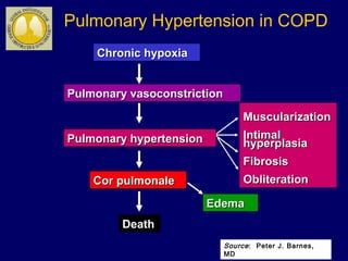 Chronic hypoxiaChronic hypoxia
Pulmonary vasoconstrictionPulmonary vasoconstriction
MuscularizationMuscularization
IntimalIntimal
hyperplasiahyperplasia
FibrosisFibrosis
ObliterationObliteration
Pulmonary hypertensionPulmonary hypertension
Cor pulmonaleCor pulmonale
Death
EdemaEdema
Pulmonary Hypertension in COPD
Source: Peter J. Barnes,
MD
 