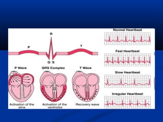 Arrhythmia. Irregular Heartbeat | PPT