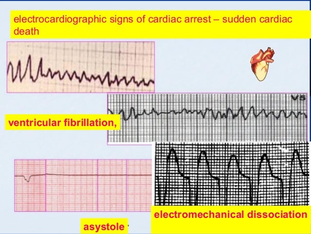 regular irregular heartbeat regular irregular heartbeat