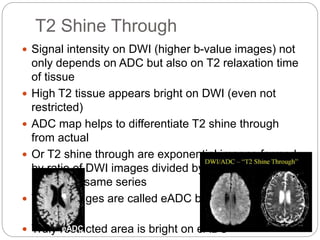 T2 Shine Through
 Signal intensity on DWI (higher b-value images) not
only depends on ADC but also on T2 relaxation time
of tissue
 High T2 tissue appears bright on DWI (even not
restricted)
 ADC map helps to differentiate T2 shine through
from actual
 Or T2 shine through are exponential images formed
by ratio of DWI images divided by T2-w (b=0)
images in same series
 These images are called eADC by some vendors
(Philips)
 Truly restricted area is bright on eADCeADC
 