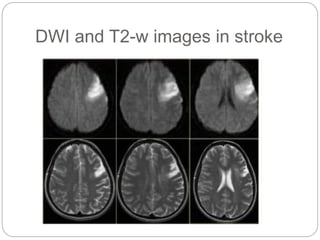 DWI and T2-w images in stroke
 
