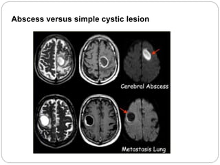 Abscess versus simple cystic lesion
 