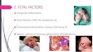 2. FETAL FACTORS
 Congenital malformations
 Fetal infections: CMV, HIV, toxoplasma, etc.
 Chromosomal abnormalities: trisomy 21 & trisomy 18
 Genetic: agenesis of pancreas, galactosemia, phenylketonuria.
 