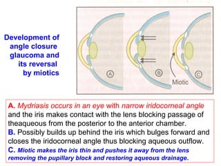 Development of
angle closure
glaucoma and
its reversal
by miotics
A. Mydriasis occurs in an eye with narrow iridocorneal angle
and the iris makes contact with the lens blocking passage of
theaqueous from the posterior to the anterior chamber.
B. Possibly builds up behind the iris which bulges forward and
closes the iridocorneal angle thus blocking aqueous outflow.
C. Miotic makes the iris thin and pushes it away from the lens
removing the pupillary block and restoring aqueous drainage.
 