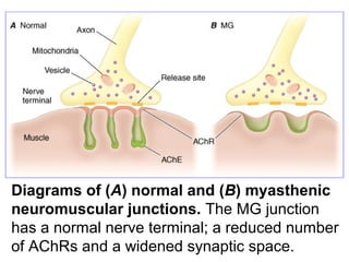 Diagrams of (A) normal and (B) myasthenic
neuromuscular junctions. The MG junction
has a normal nerve terminal; a reduced number
of AChRs and a widened synaptic space.
 